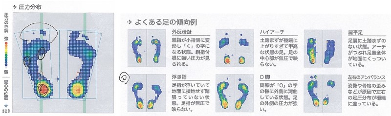 足の圧力分布とよくある足の傾向例